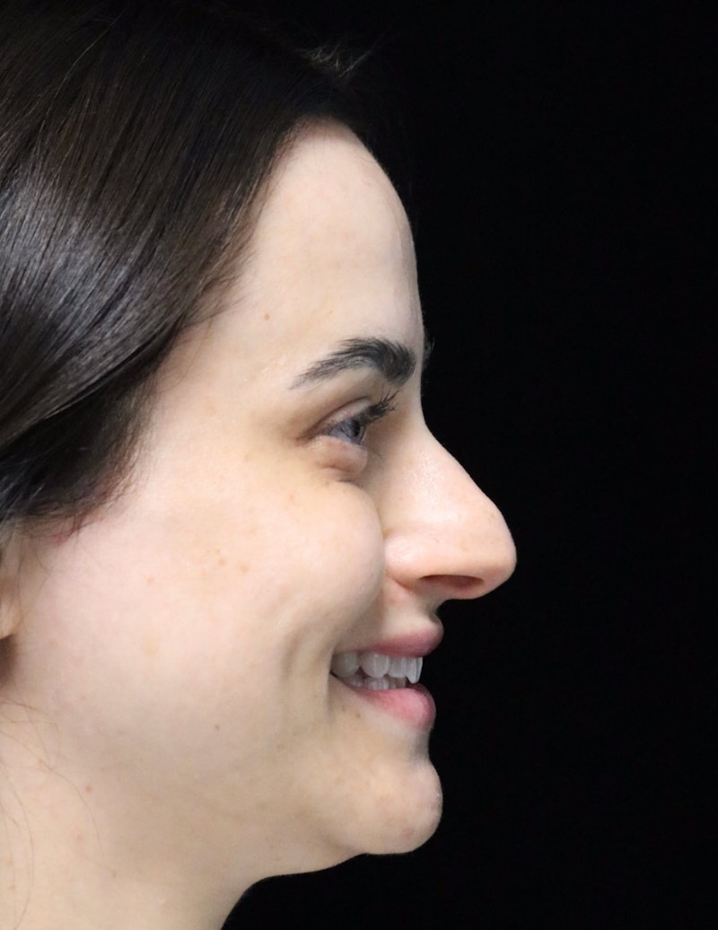 Beverly Hills Rhinoplasty Before & After Gallery - Patient 251812 - Image 3 Dr. Deepak Raj Dugar