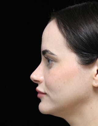 Beverly Hills Rhinoplasty Before & After Gallery - Patient 251812 - Image 6 Dr. Deepak Raj Dugar