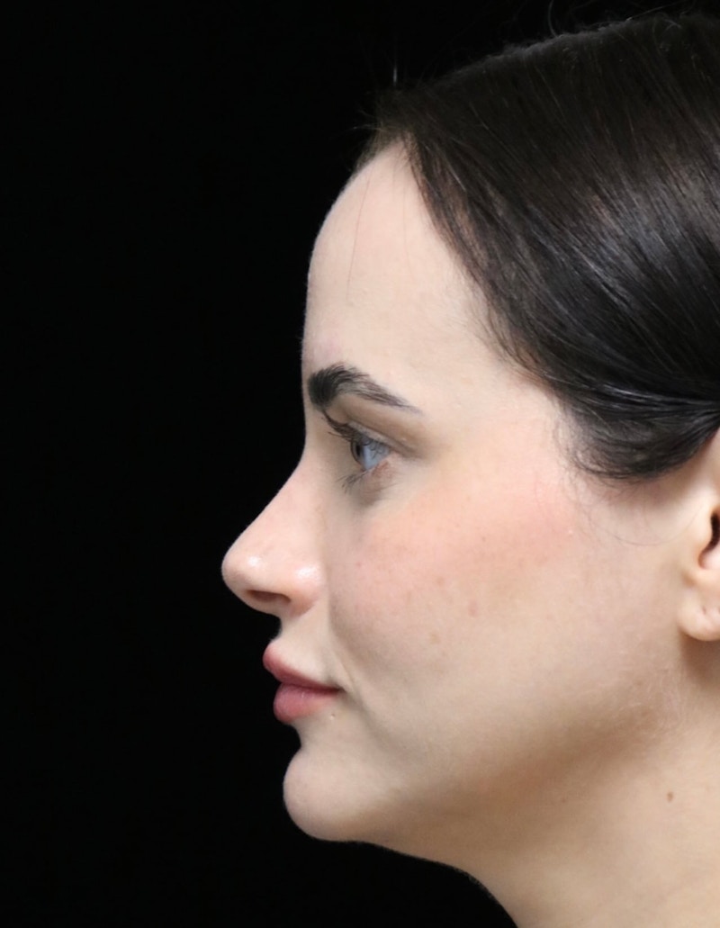 Beverly Hills Rhinoplasty Before & After Gallery - Patient 251812 - Image 6 Dr. Deepak Raj Dugar