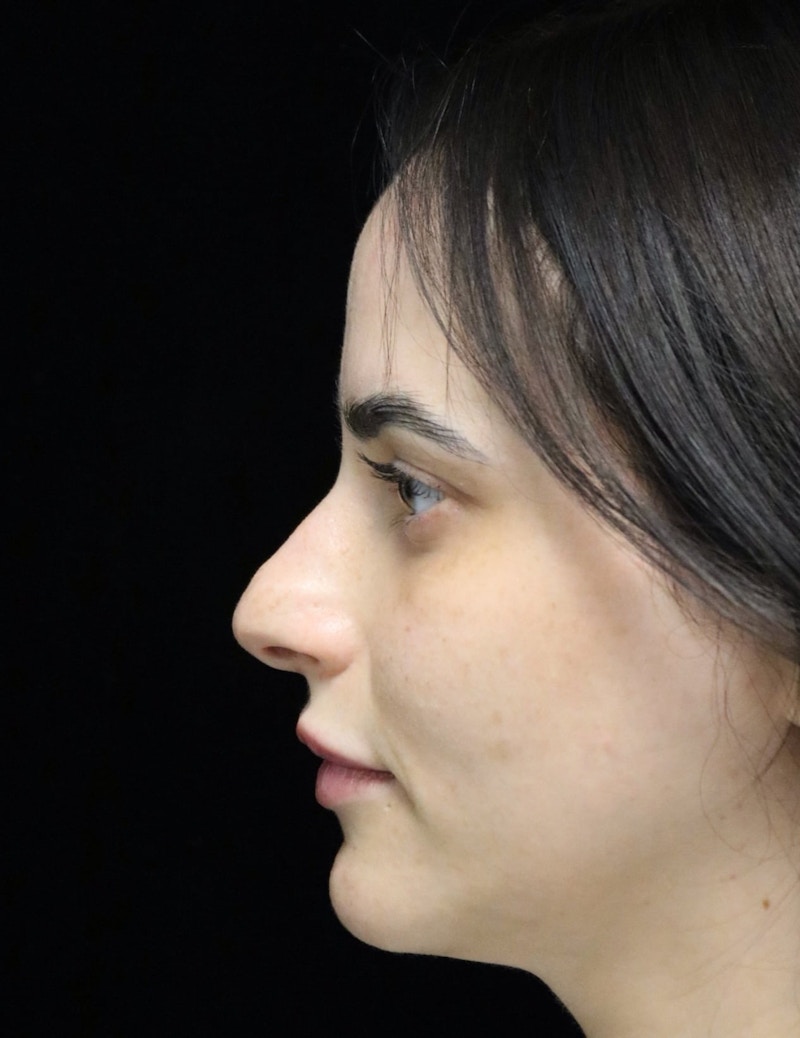 Beverly Hills Rhinoplasty Before & After Gallery - Patient 251812 - Image 5 Dr. Deepak Raj Dugar
