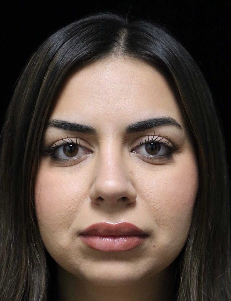 Beverly Hills Rhinoplasty Before & After Gallery - Patient 234419 - Image 10 Dr. Deepak Raj Dugar