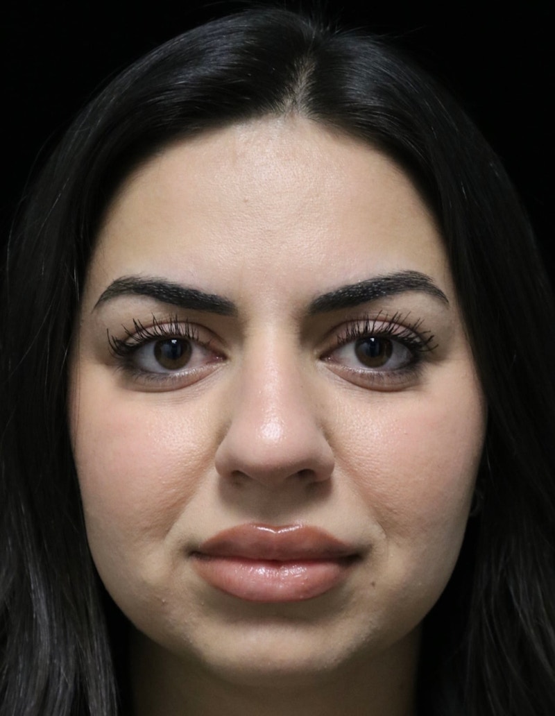 Beverly Hills Rhinoplasty Before & After Gallery - Patient 234419 - Image 9 Dr. Deepak Raj Dugar