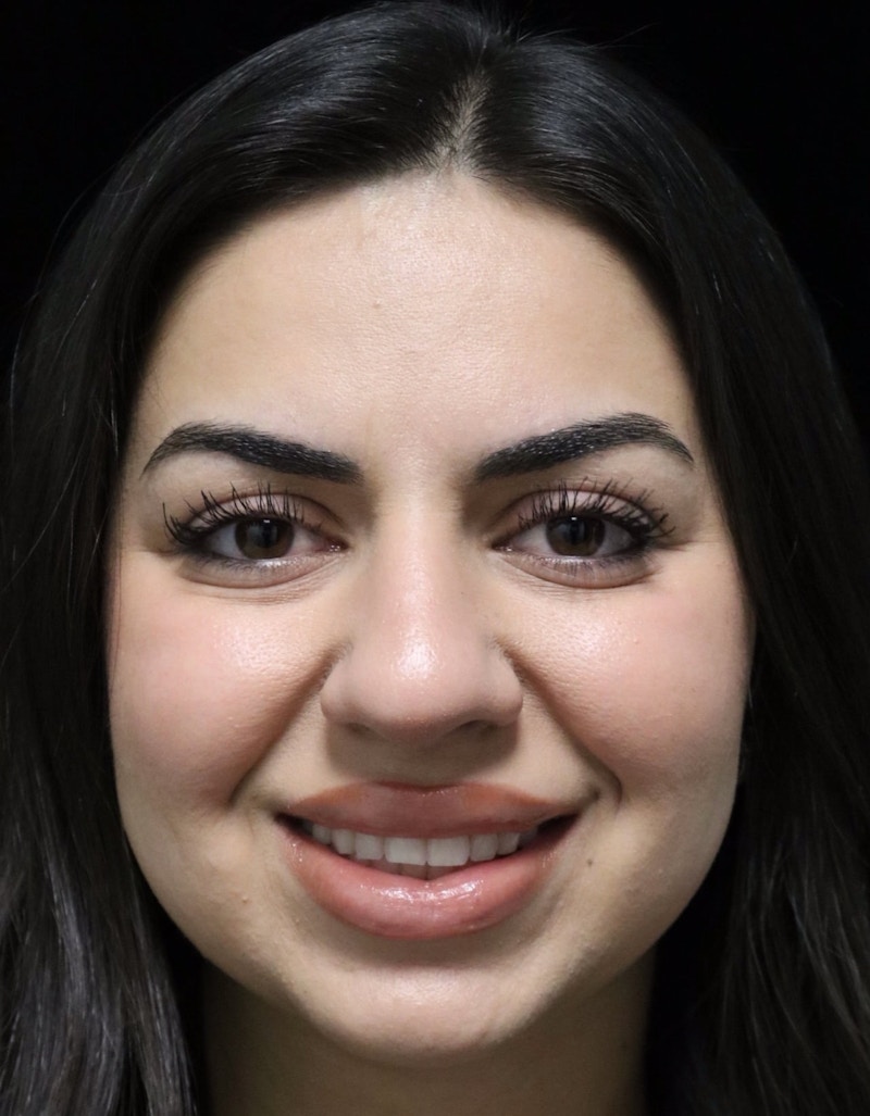 Beverly Hills Rhinoplasty Before & After Gallery - Patient 234419 - Image 11 Dr. Deepak Raj Dugar