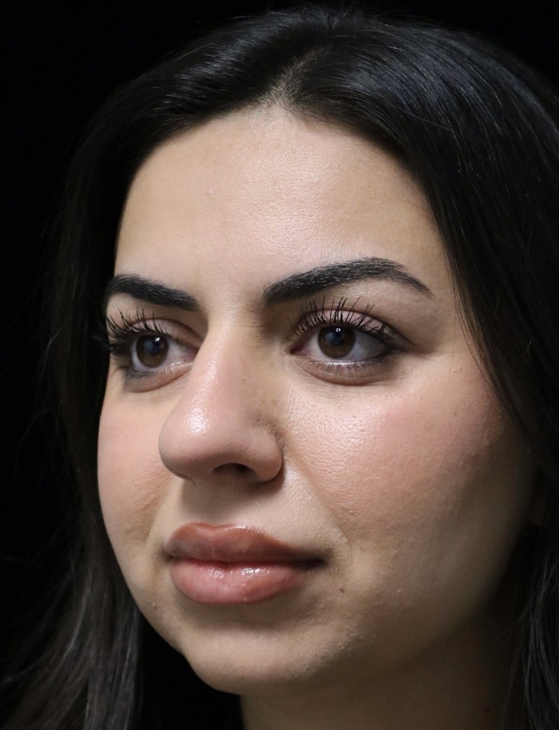 Beverly Hills Rhinoplasty Before & After Gallery - Patient 234419 - Image 7 Dr. Deepak Raj Dugar
