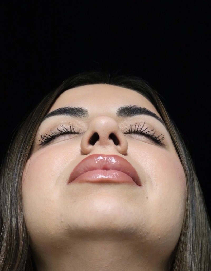 Beverly Hills Rhinoplasty Before & After Gallery - Patient 234419 - Image 14 Dr. Deepak Raj Dugar