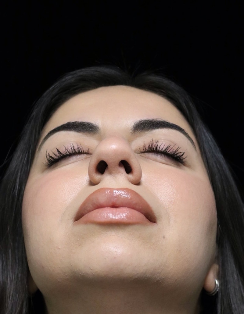 Beverly Hills Rhinoplasty Before & After Gallery - Patient 234419 - Image 13 Dr. Deepak Raj Dugar