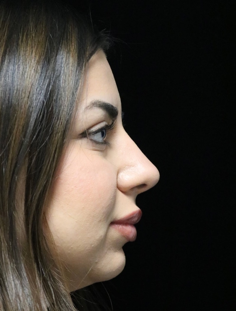 Beverly Hills Rhinoplasty Before & After Gallery - Patient 234419 - Image 2 Dr. Deepak Raj Dugar