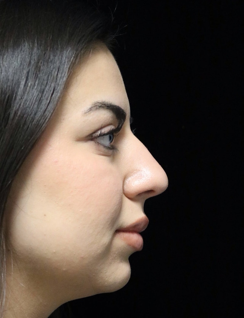 Beverly Hills Rhinoplasty Before & After Gallery - Patient 234419 - Image 1 Dr. Deepak Raj Dugar