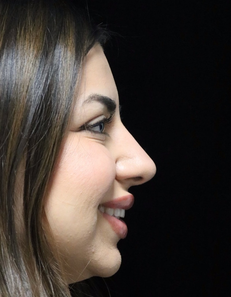 Beverly Hills Rhinoplasty Before & After Gallery - Patient 234419 - Image 4 Dr. Deepak Raj Dugar