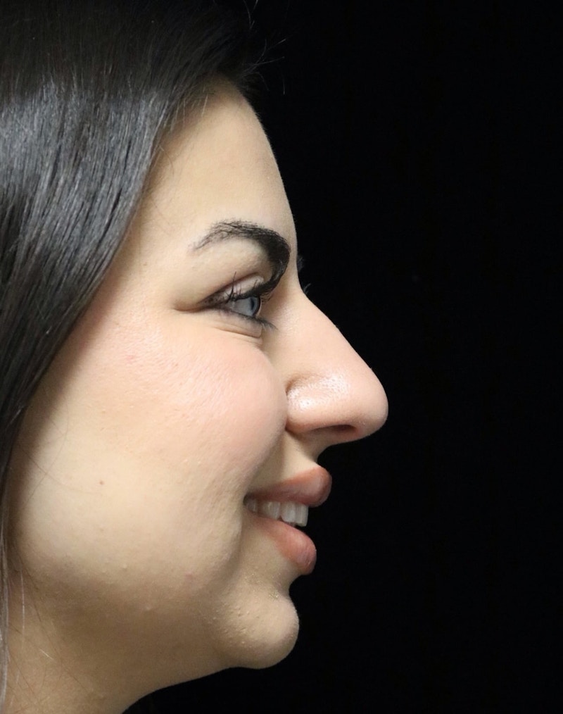 Beverly Hills Rhinoplasty Before & After Gallery - Patient 234419 - Image 3 Dr. Deepak Raj Dugar