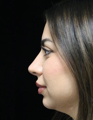 Beverly Hills Rhinoplasty Before & After Gallery - Patient 234419 - Image 6 Dr. Deepak Raj Dugar