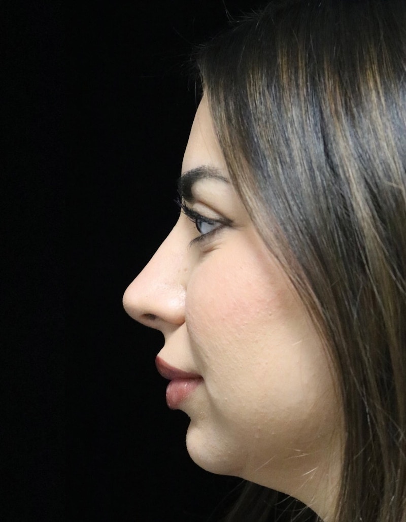 Beverly Hills Rhinoplasty Before & After Gallery - Patient 234419 - Image 6 Dr. Deepak Raj Dugar