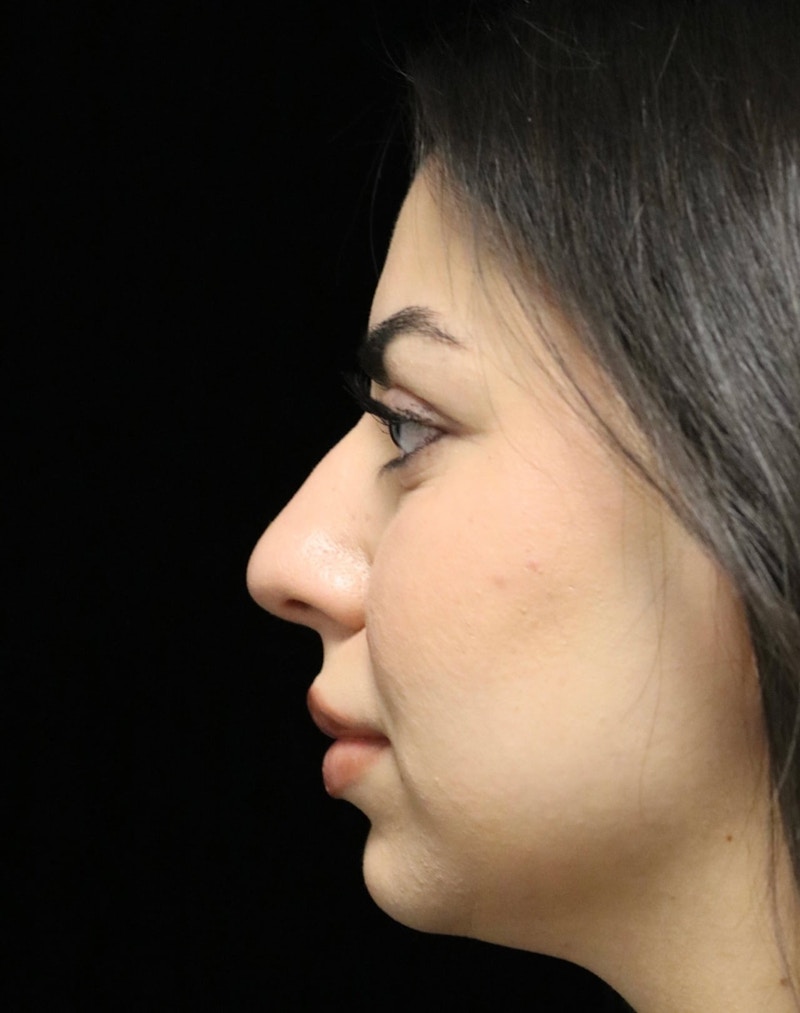 Beverly Hills Rhinoplasty Before & After Gallery - Patient 234419 - Image 5 Dr. Deepak Raj Dugar