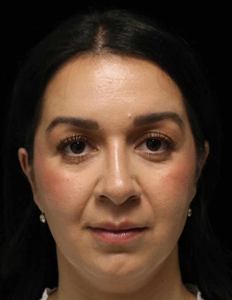 Beverly Hills Rhinoplasty Before & After Gallery - Patient 331540 - Image 10 Dr. Deepak Raj Dugar