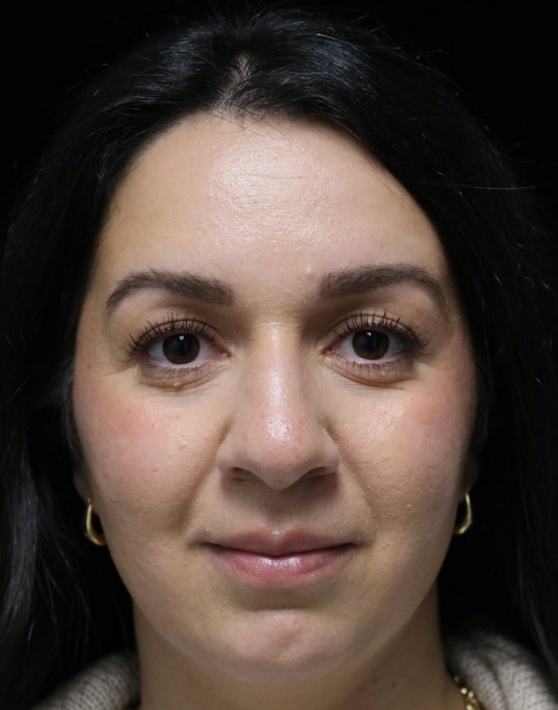 Beverly Hills Rhinoplasty Before & After Gallery - Patient 331540 - Image 9 Dr. Deepak Raj Dugar