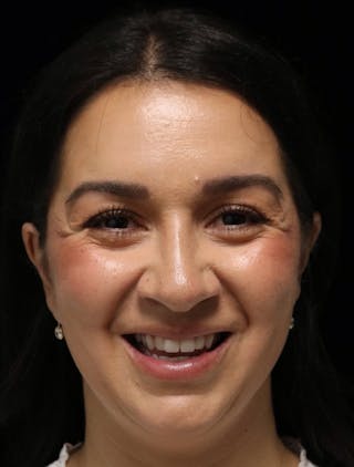 Beverly Hills Rhinoplasty Before & After Gallery - Patient 331540 - Image 12 Dr. Deepak Raj Dugar
