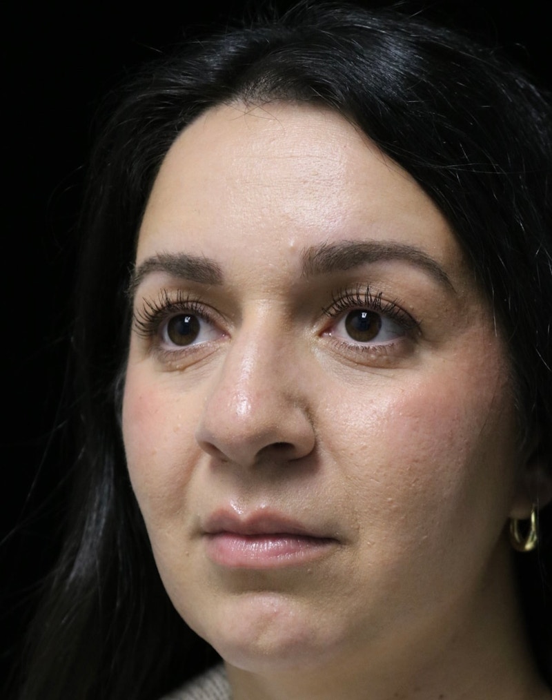 Beverly Hills Rhinoplasty Before & After Gallery - Patient 331540 - Image 7 Dr. Deepak Raj Dugar