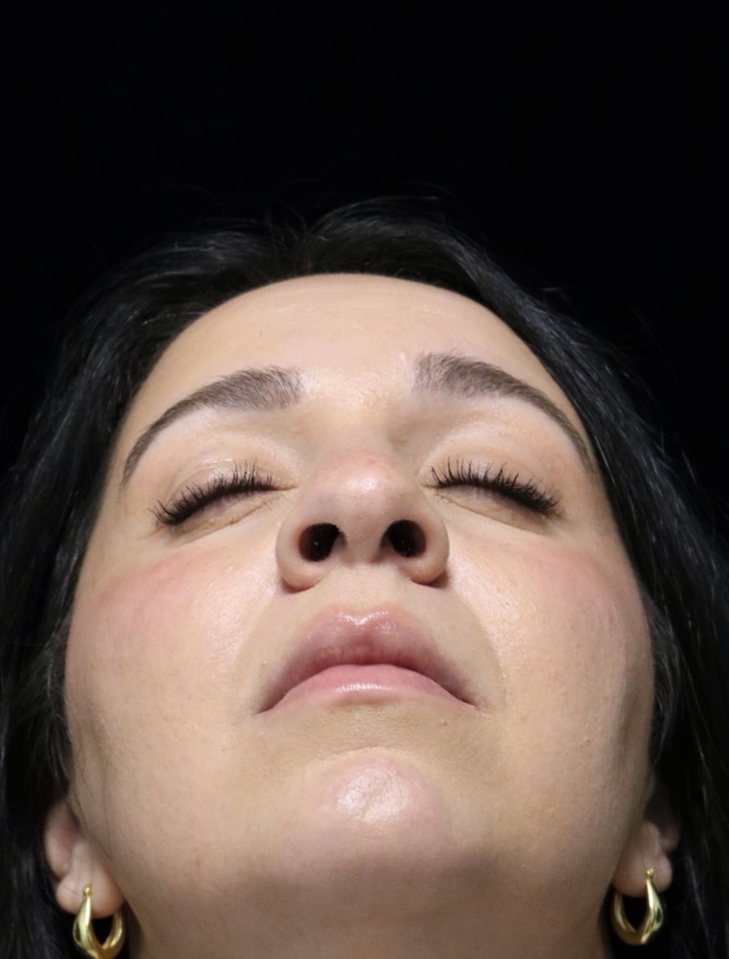 Beverly Hills Rhinoplasty Before & After Gallery - Patient 331540 - Image 13 Dr. Deepak Raj Dugar