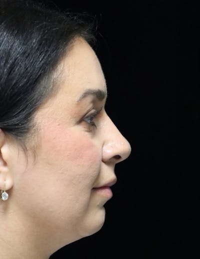 Beverly Hills Rhinoplasty Before & After Gallery - Patient 331540 - Image 2 Dr. Deepak Raj Dugar