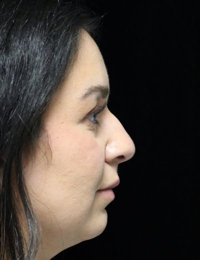 Rhinoplasty Before & After Gallery - Patient 331540 - Image 1