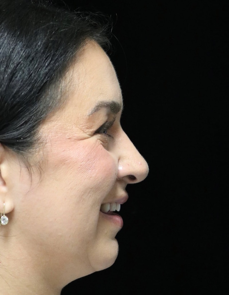 Beverly Hills Rhinoplasty Before & After Gallery - Patient 331540 - Image 4 Dr. Deepak Raj Dugar