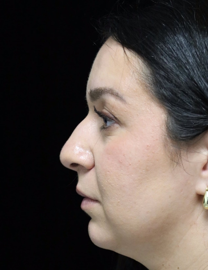 Beverly Hills Rhinoplasty Before & After Gallery - Patient 331540 - Image 5 Dr. Deepak Raj Dugar