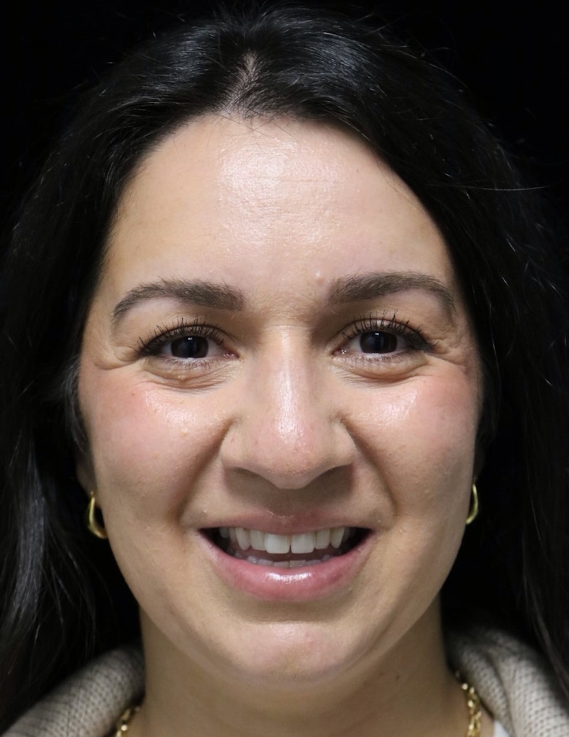 Beverly Hills Rhinoplasty Before & After Gallery - Patient 331540 - Image 11 Dr. Deepak Raj Dugar