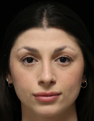 Beverly Hills Rhinoplasty Before & After Gallery - Patient 274643 - Image 10 Dr. Deepak Raj Dugar