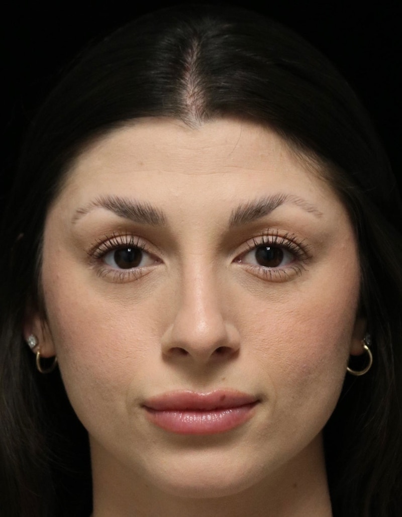 Beverly Hills Rhinoplasty Before & After Gallery - Patient 274643 - Image 10 Dr. Deepak Raj Dugar