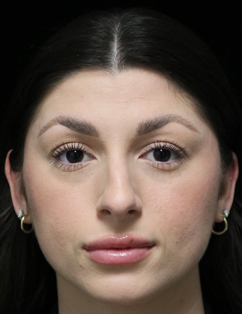 Beverly Hills Rhinoplasty Before & After Gallery - Patient 274643 - Image 9 Dr. Deepak Raj Dugar