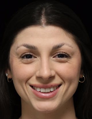 Beverly Hills Rhinoplasty Before & After Gallery - Patient 274643 - Image 12 Dr. Deepak Raj Dugar