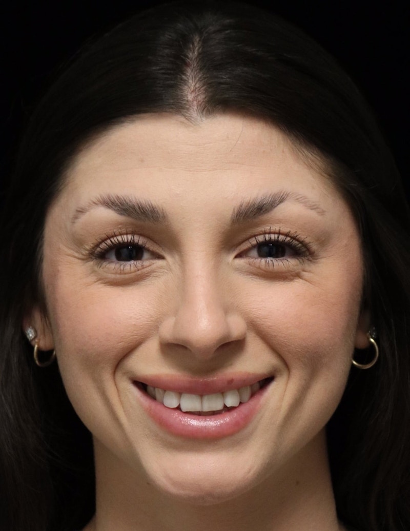 Beverly Hills Rhinoplasty Before & After Gallery - Patient 274643 - Image 12 Dr. Deepak Raj Dugar