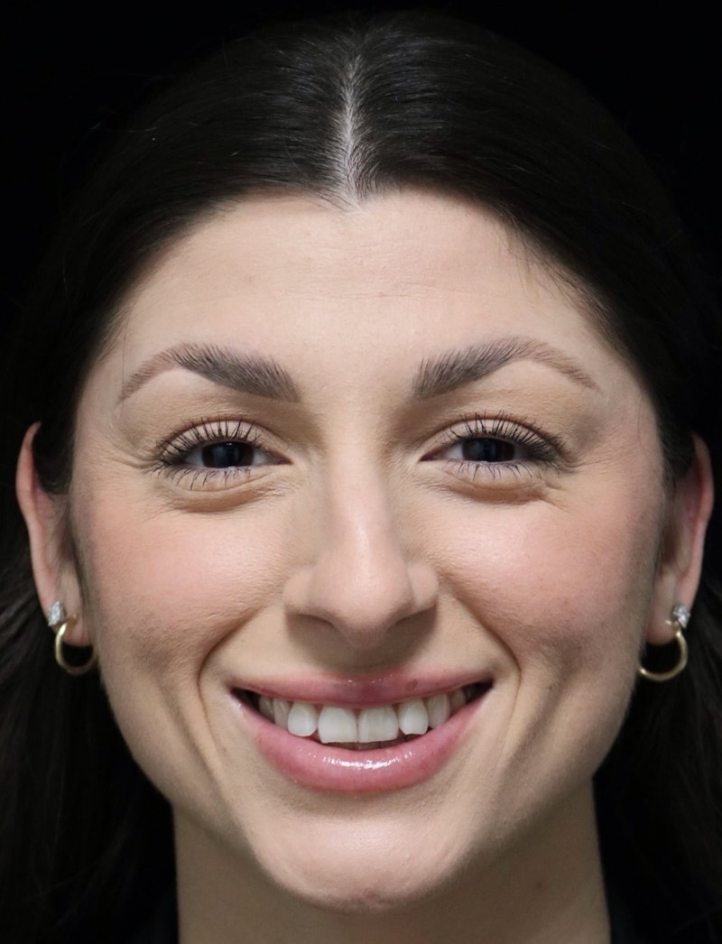 Beverly Hills Rhinoplasty Before & After Gallery - Patient 274643 - Image 11 Dr. Deepak Raj Dugar