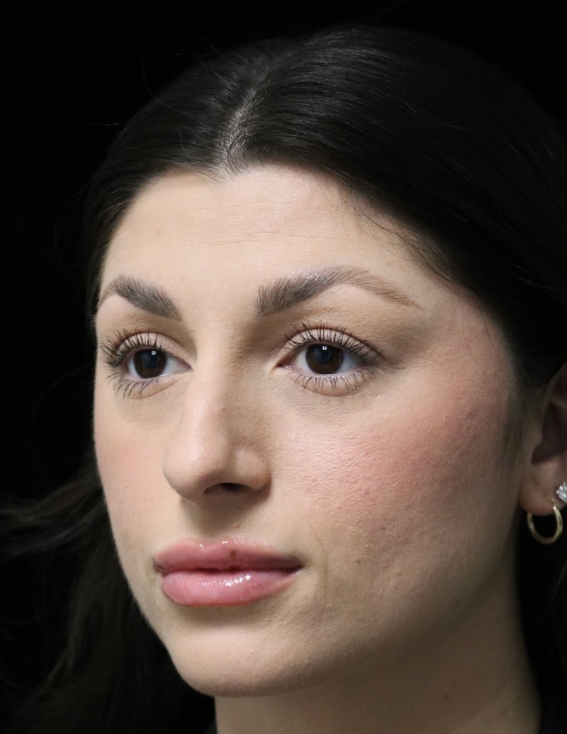 Beverly Hills Rhinoplasty Before & After Gallery - Patient 274643 - Image 7 Dr. Deepak Raj Dugar