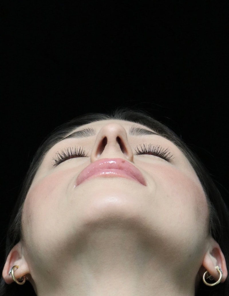 Beverly Hills Rhinoplasty Before & After Gallery - Patient 274643 - Image 13 Dr. Deepak Raj Dugar