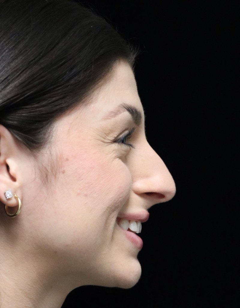 Beverly Hills Rhinoplasty Before & After Gallery - Patient 274643 - Image 3 Dr. Deepak Raj Dugar