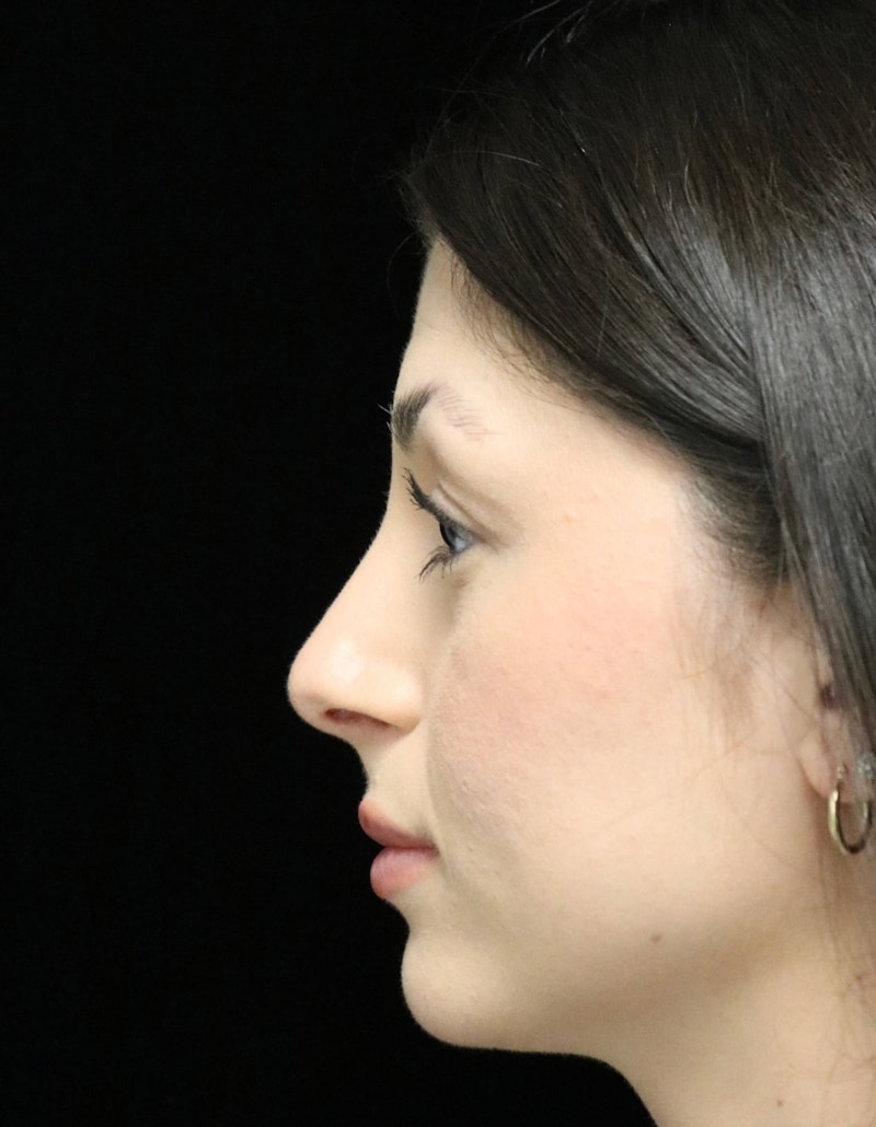 Beverly Hills Rhinoplasty Before & After Gallery - Patient 274643 - Image 6 Dr. Deepak Raj Dugar