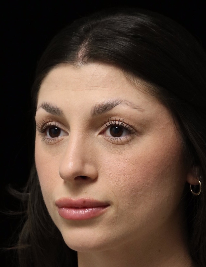 Beverly Hills Rhinoplasty Before & After Gallery - Patient 274643 - Image 8 Dr. Deepak Raj Dugar