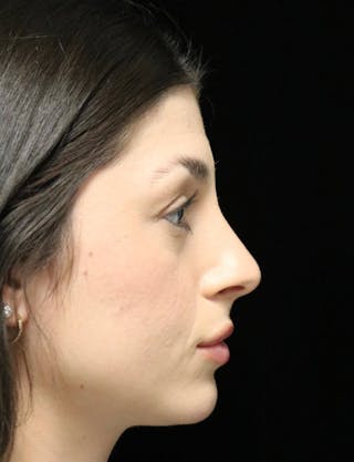 Beverly Hills Rhinoplasty Before & After Gallery - Patient 274643 - Image 2 Dr. Deepak Raj Dugar