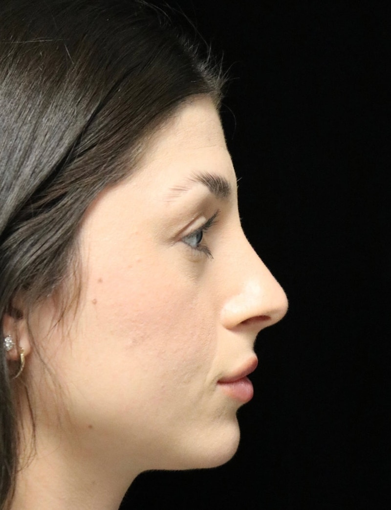 Beverly Hills Rhinoplasty Before & After Gallery - Patient 274643 - Image 2 Dr. Deepak Raj Dugar