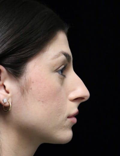 Rhinoplasty Before & After Gallery - Patient 274643 - Image 1