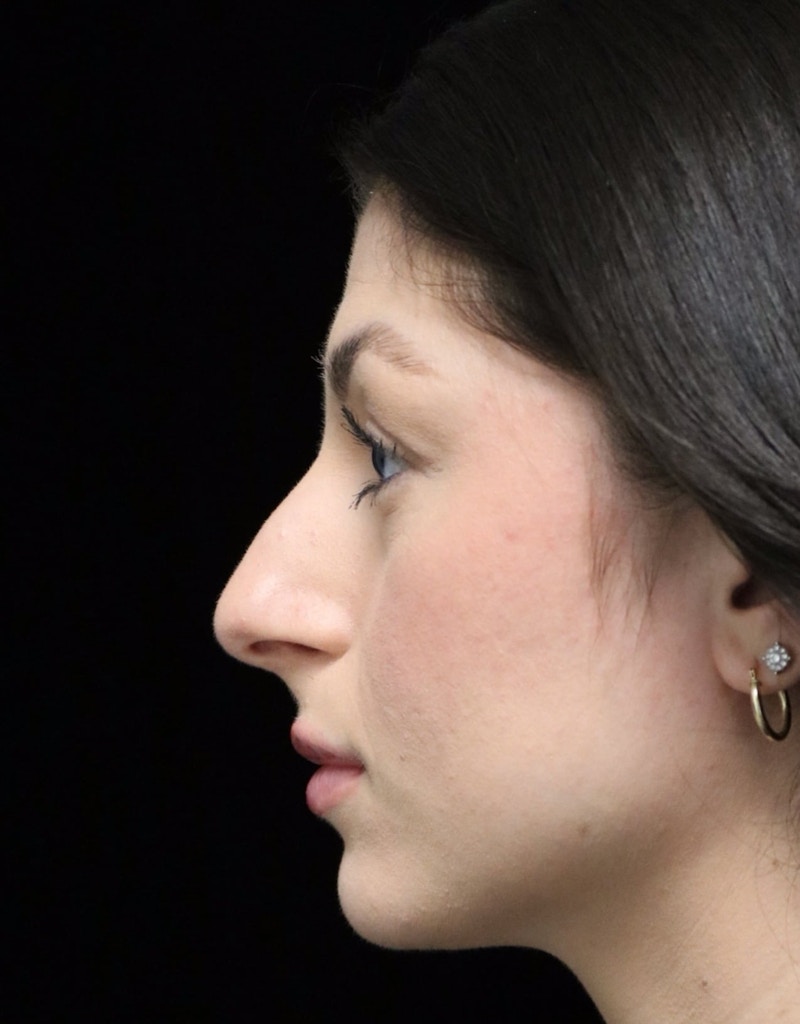 Beverly Hills Rhinoplasty Before & After Gallery - Patient 274643 - Image 5 Dr. Deepak Raj Dugar