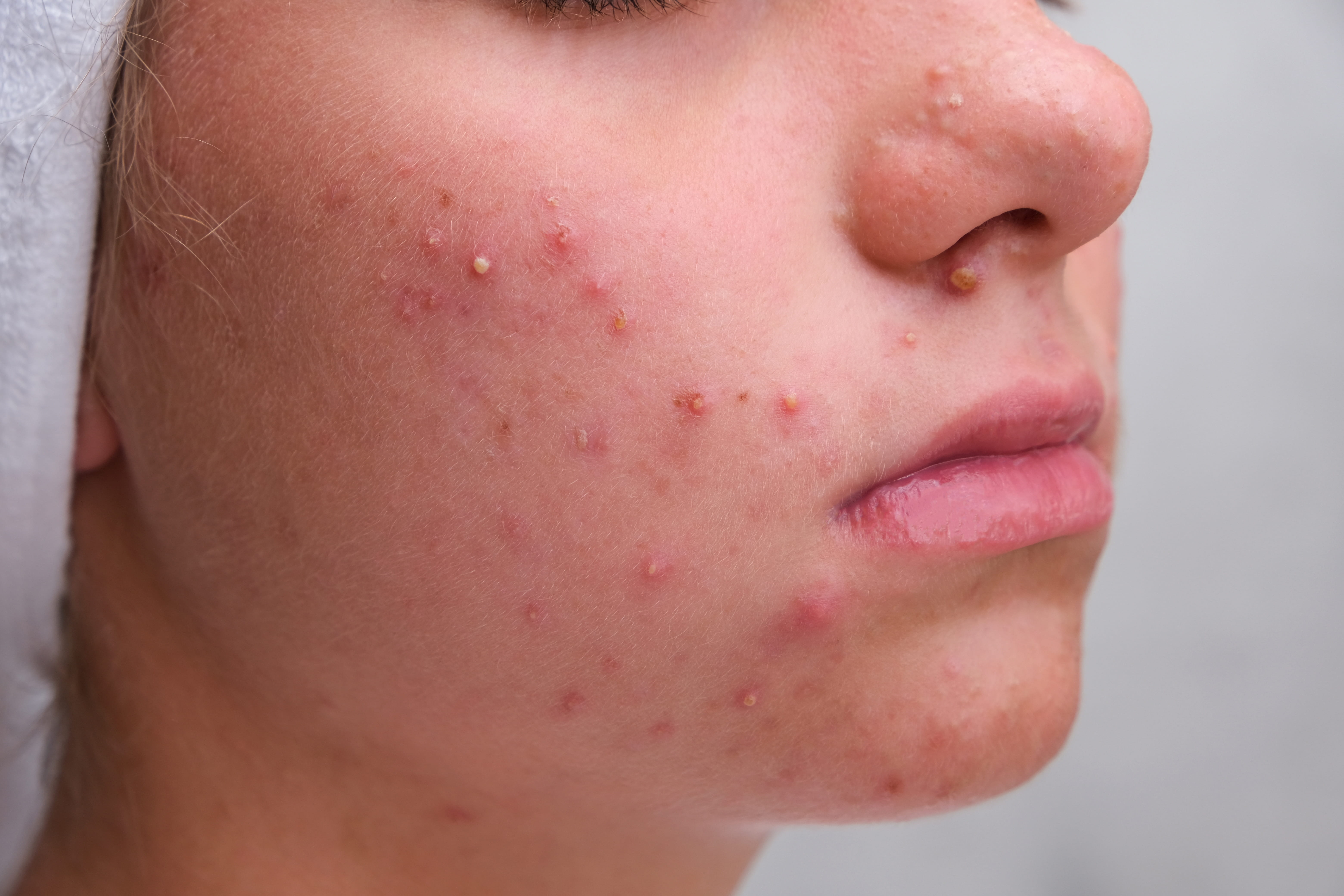 Close-up of acne-prone skin with spots and redness across the cheek and jawline