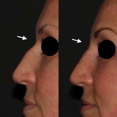 Fillers Before & After Gallery - Patient 295524 - Image 1