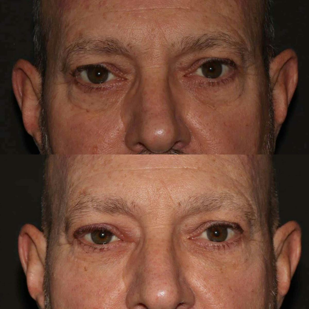 Fillers Before & After Gallery - Patient 233589 - Image 1