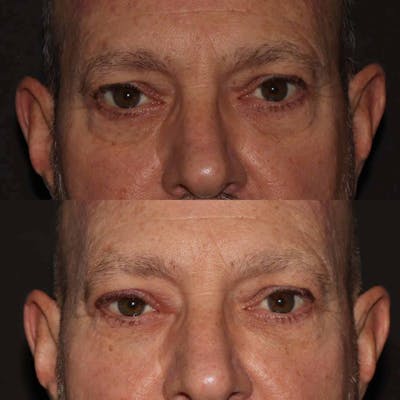 Fillers Before & After Gallery - Patient 233589 - Image 1