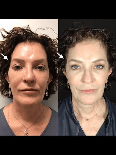 Fillers Before & After Gallery - Patient 137314 - Image 1