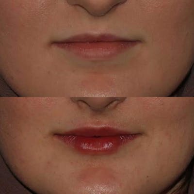 Fillers Before & After Gallery - Patient 557243 - Image 1