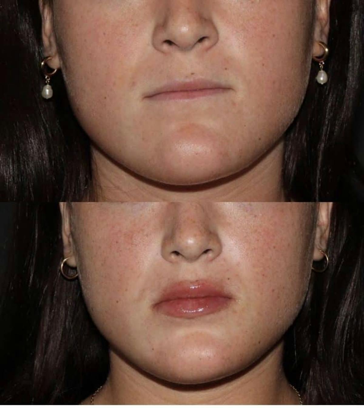 Fillers Before & After Gallery - Patient 411652 - Image 1