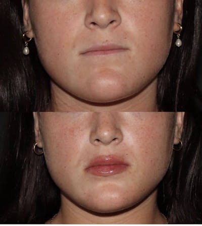 Fillers Before & After Gallery - Patient 411652 - Image 1